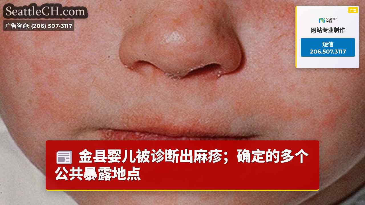金县婴儿被诊断出麻疹；确定的多个公共暴露地点