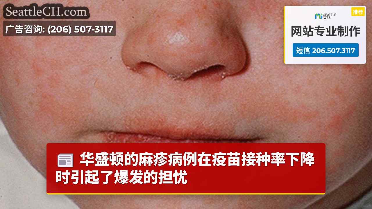 华盛顿的麻疹病例在疫苗接种率下降时引起了爆发的担忧