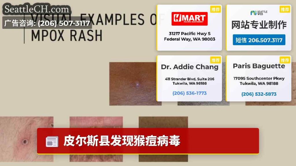皮尔斯县发现猴痘病毒