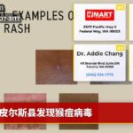 皮尔斯县发现猴痘病毒