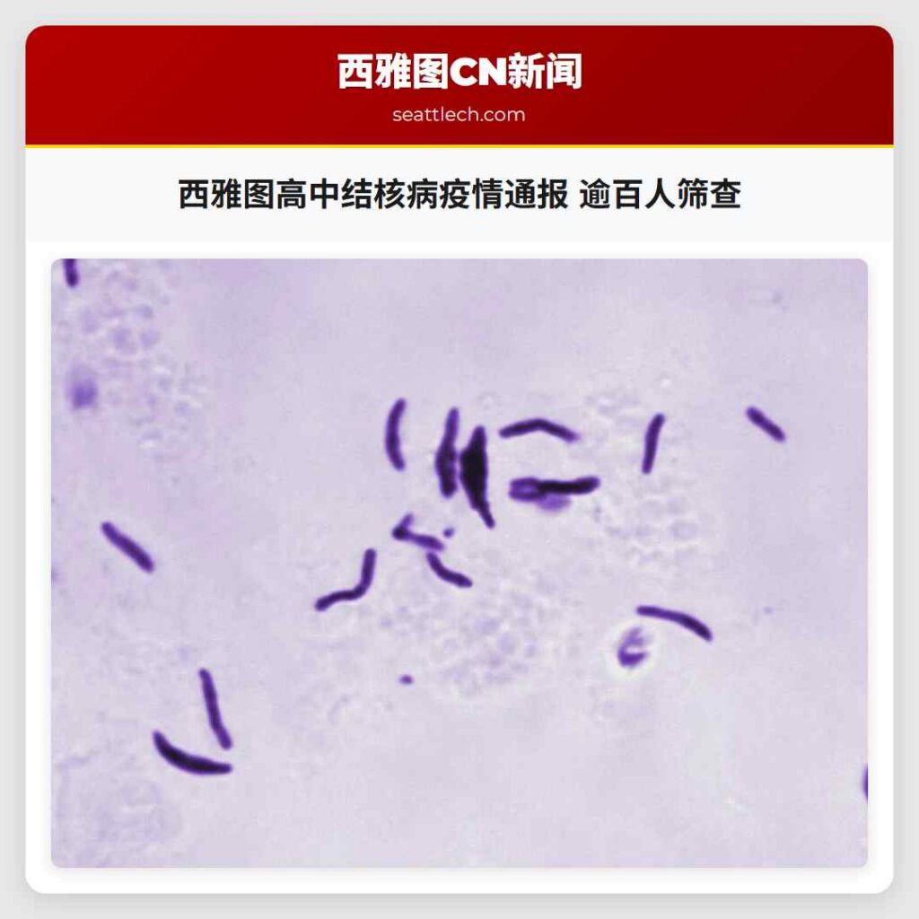 西雅图高中结核病疫情通报 逾百人筛查