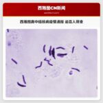 西雅图高中结核病疫情通报：逾百人接受筛查