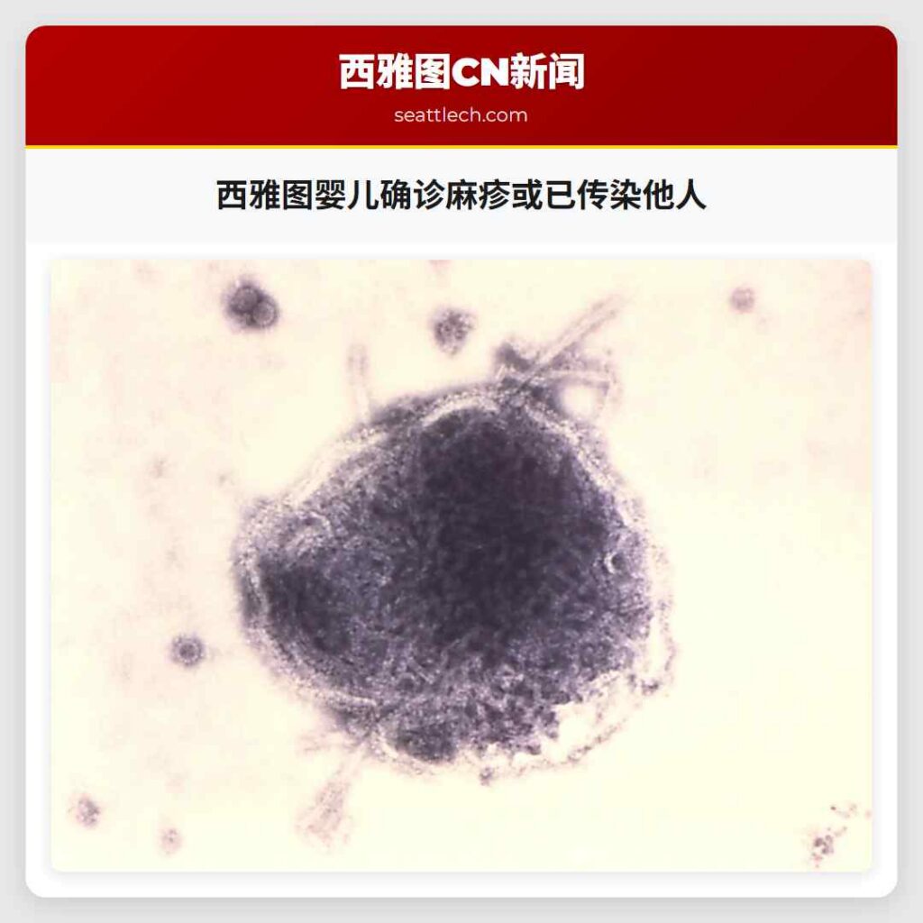 西雅图婴儿确诊麻疹或已传染他人